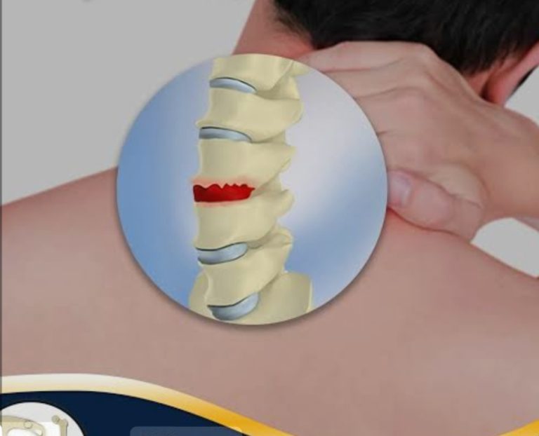 طق رقبتك ترتاح! عادة يوميةقد تسبب لك مشاكل في الشرايين و الفقرات
